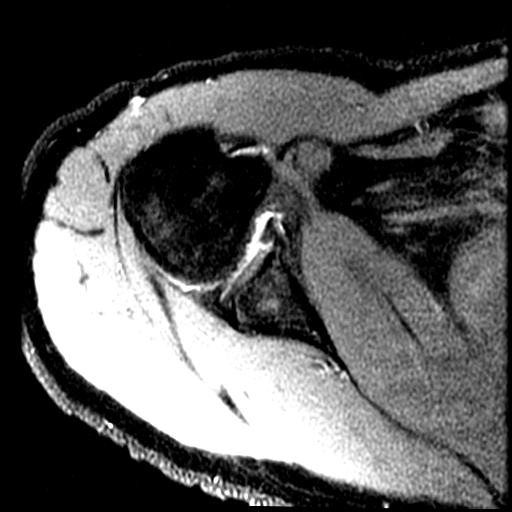 Figure 2 for case GLAD lesion